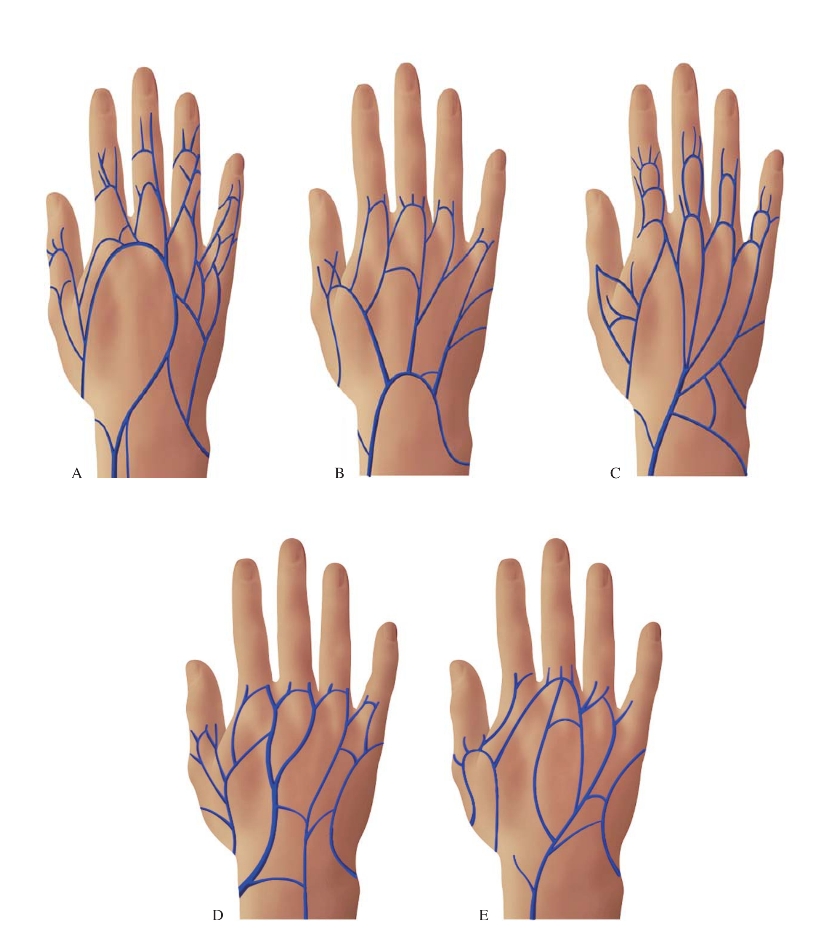 弓型:掌背静脉于手背形成一大静脉弓,此型较多;b.