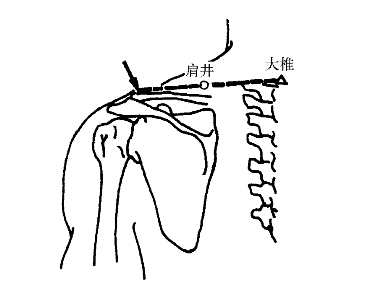 图1-10 肩井图1-11 巨骨(十二)巨骨【定位】 锁骨肩峰端与肩胛岗之间
