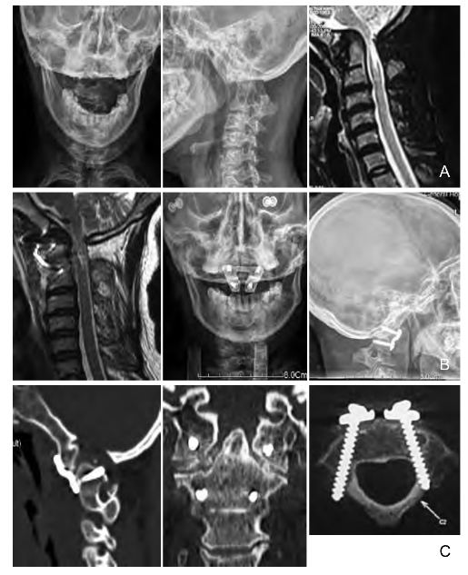 术前x线片及术前mr提示颅底陷入,寰枢椎前脱位,延髓受压;b.