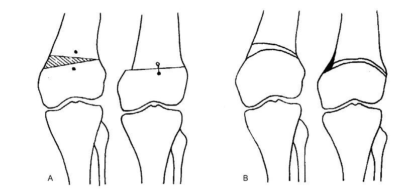 膝关节骨性关节炎股骨远端截骨术关节镜手术与康复