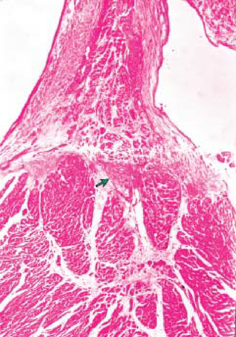 图12-12(b) 肥厚性心肌病hb纤维组织增生 hb胶原纤维增生,与肌隔顶部