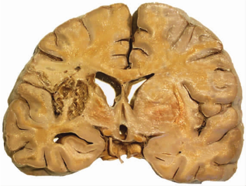 图2-16 脑液化性坏死(3)纤维素样坏死:旧称纤维素样变性,是结缔组织