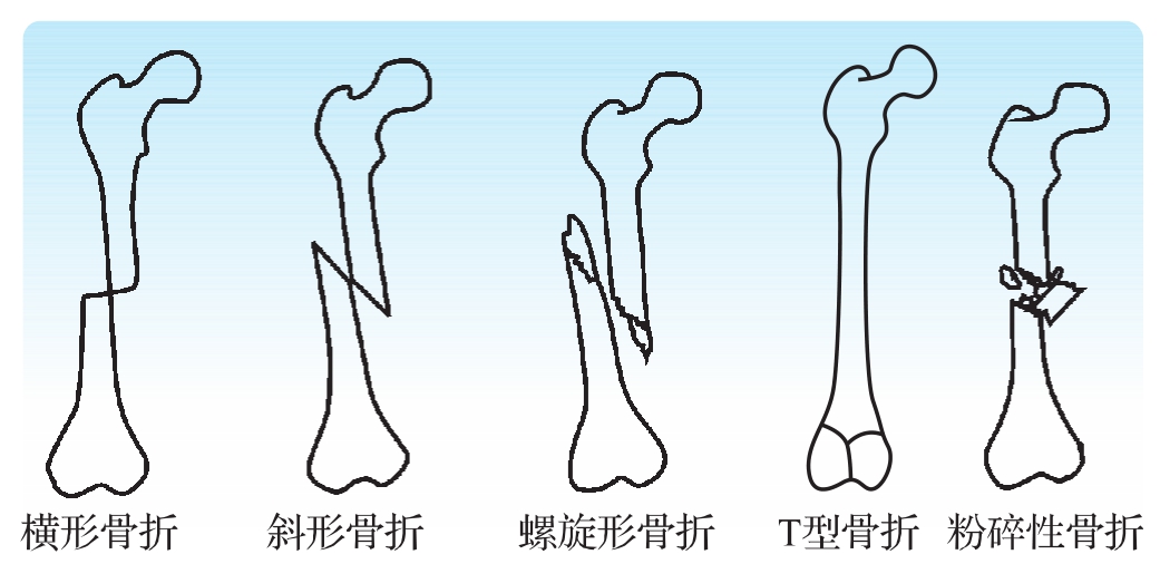 (5)嵌插骨折:骨折片相互嵌插,多见于干骺端骨折.