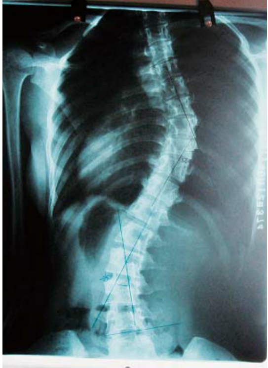 脊柱侧凸矫形器治疗方法的有关介绍青少年脊柱侧凸病