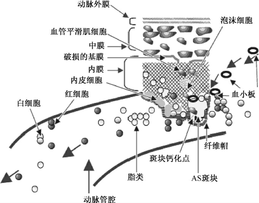 动脉粥样硬化发生和发展的分子机制