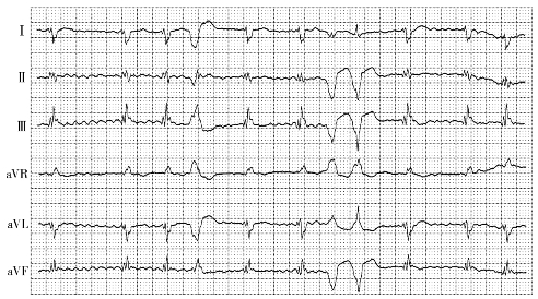 洋地黄效应心电图表现图片