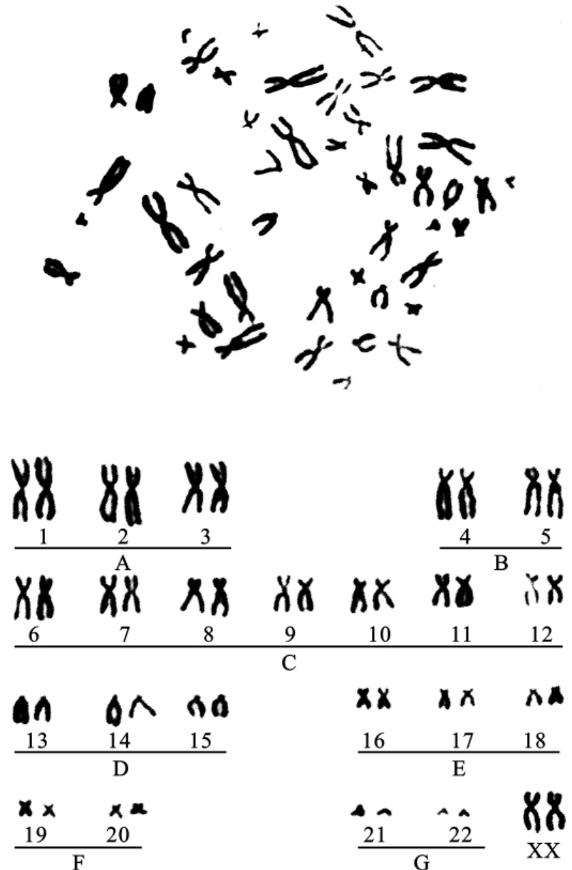 非显带核型(46,xy)着丝粒指数=短臂长度/该条染色体全长(2)着丝粒指数