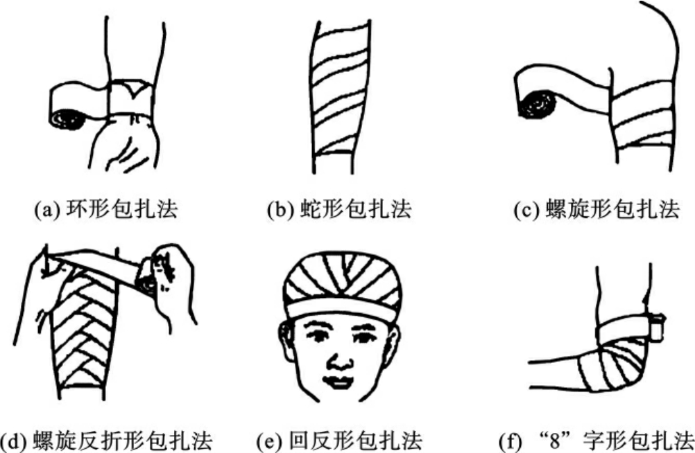 ①绷带的6种基本包扎法:环形包扎法,蛇形包扎法,螺旋形包扎法,螺旋反