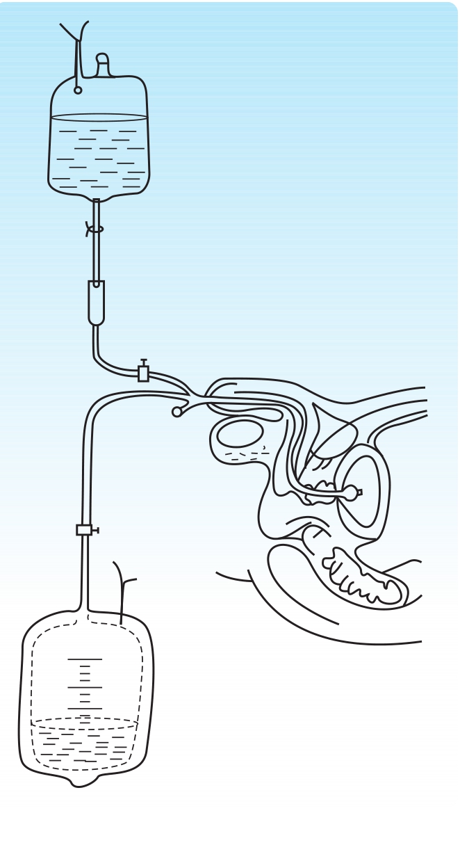 袋高应距病人骨盆100cm左右,经输液管连接三腔导尿管或膀胱造口管